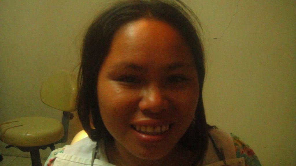 maricel - post surgery