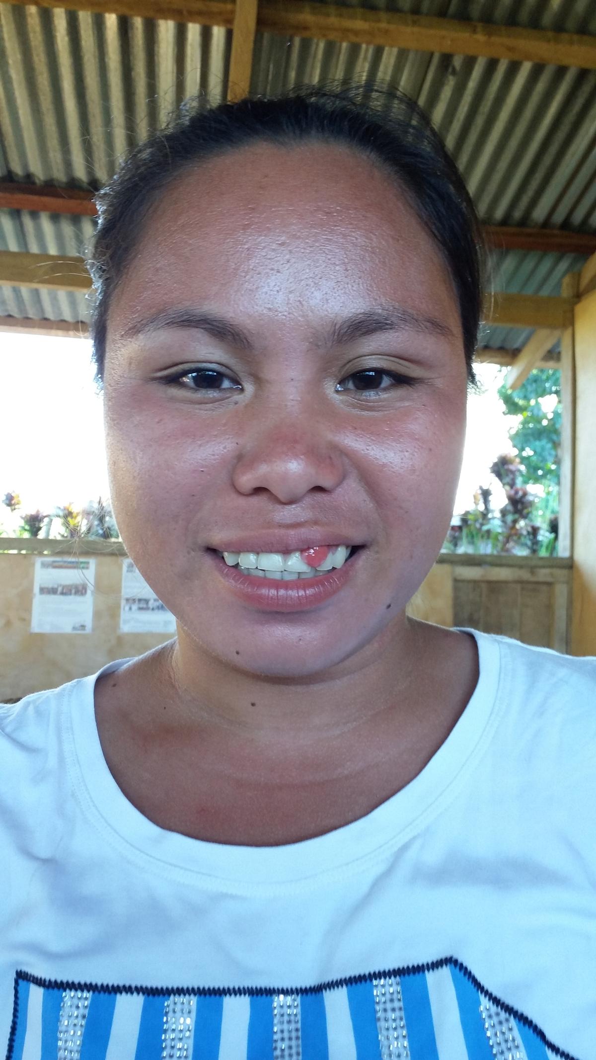 maricel - presurgery